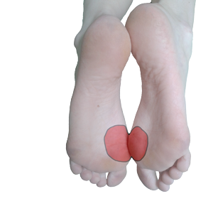 Halux valgus
