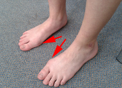Halux valgus